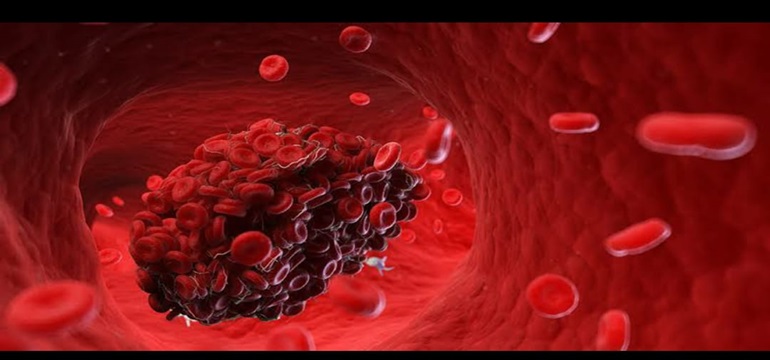 Inilah Penyebab Darah Menstruasi Menggumpal dan Cara Mengatasinya
